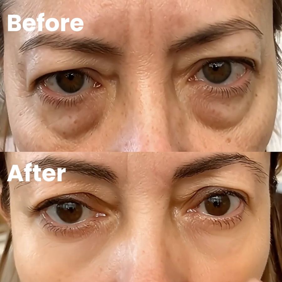 Under-eye bags before and after
