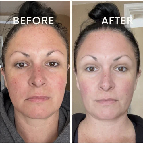 Before and after 2 — Nuvetra Lymphatic Face Brush