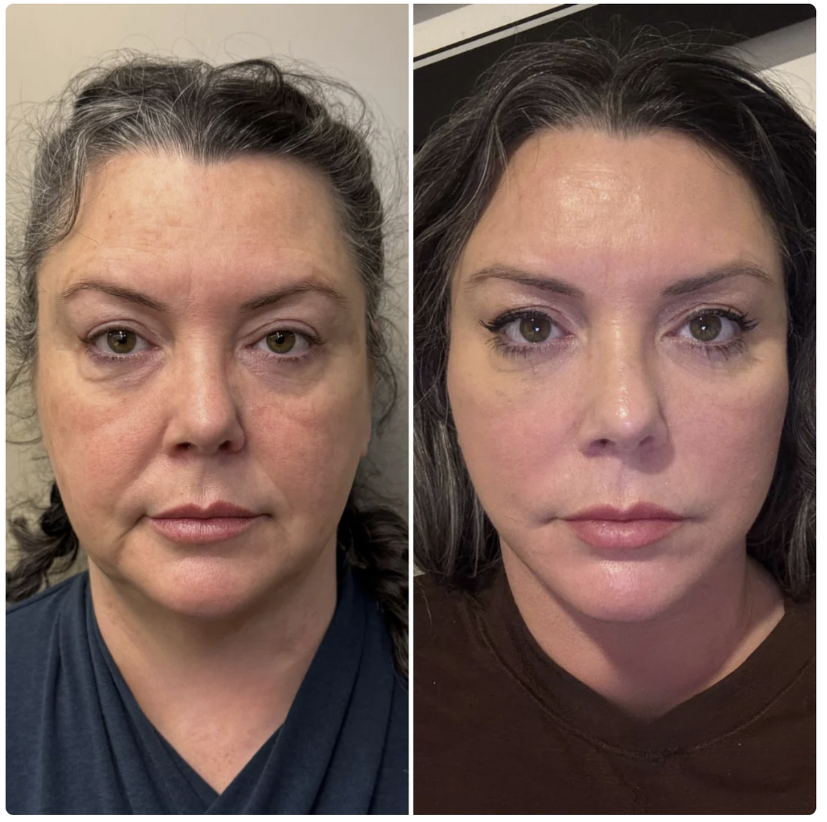 Before and after 3 — Nuvetra Lymphatic Face Brush