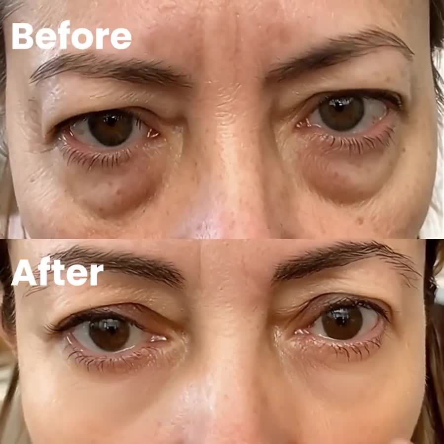 Under-eye area before and after one session